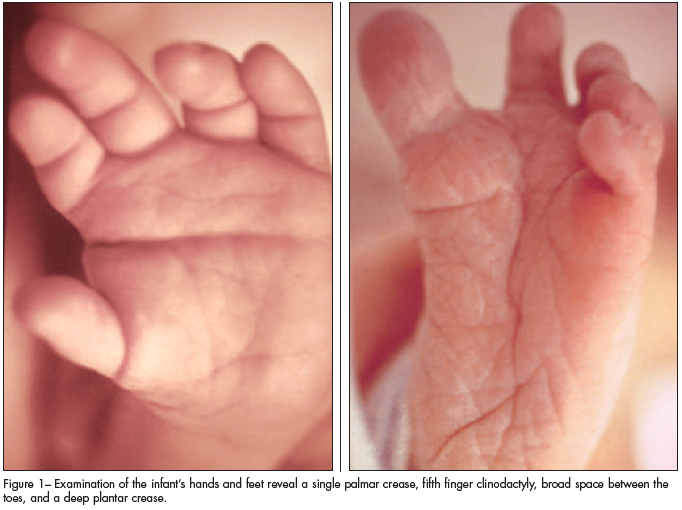 19+ Plantar Creases Newborn FarajFeiting